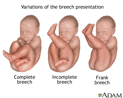 Breech babies!